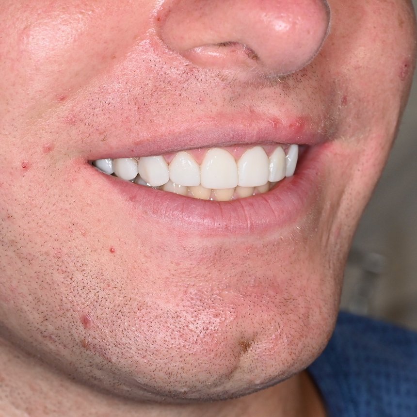After — One Smile Aesthetics smile design